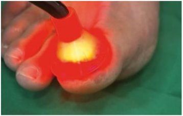 Fungal Nail Infection Laser Treatment
