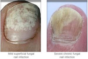 PACT Treatment for Fungal Nails - Lefort Podiatry Forest Hill